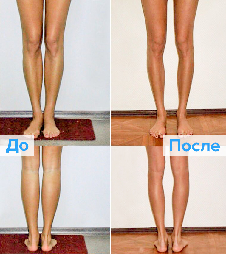Круропластика ног. Круропластика голени асимметрия голени.